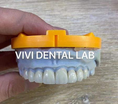 Ivoclar Emax Laminate Veneers Translucent Profesional Tingkat Tinggi China Dental Lab