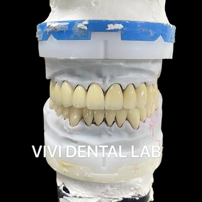 Digital CAD CAM Dental Lab Mahkota Translucent Lapisan Zirconia Mahkota
