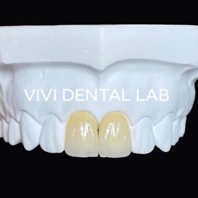 Full Jaw Dental Zirconia Bridge Implantasi Mahkota Translucence Estetika
