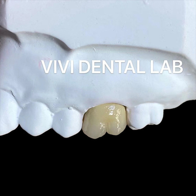 Be Ni Free Metal Porselen Mahkota PFM Mahkota China Dental Lab