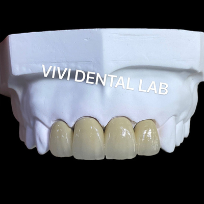 PFM Dental Lab Crown SLM Teknik Dengan Scheftner 30 Alloy Powder