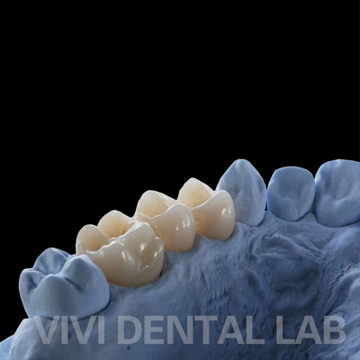 Full Contour Dental Lab Mahkota Translucence Tinggi Solid Zirconia Mahkota