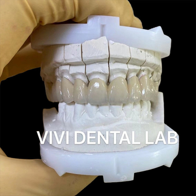 Jual-jual Korona Lab Gigi Precision Estetika Porselen Zirconia Crown Gigi