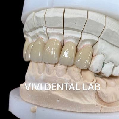 Satu Lapisan Telescopic Dental Lab Mahkota Zirconia Noritake Porselen