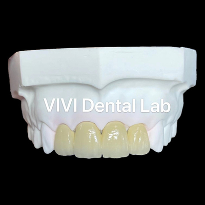 Zirconia Mahkota PFZ Zirconia Porselen Mahkota Dental Mahkota Gigi