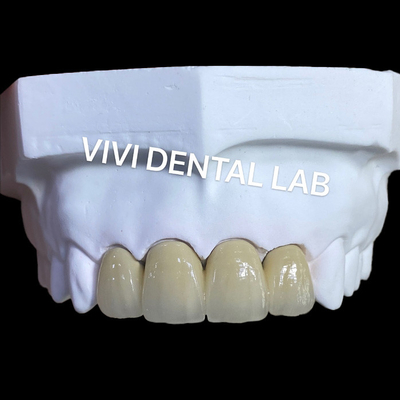 Metal Keramik Mahkota PFM Mahkota dan Jembatan dari China Dental Lab