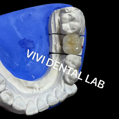 Ivoclar Scheftner Metal Porcelain Crowns Metal Ceramic Crowns Ni Be free