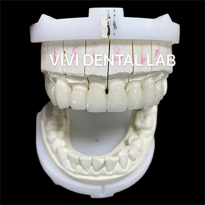 Estetika Tinggi Zirconia Dental Lab Mahkota Jembatan Dengan Porselen Lapisan