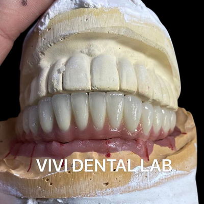 Implan Gigi Jembatan Keramik Logam Pada Titanium Abutments
