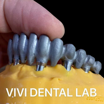 Jembatan PFM yang dicetak dari Multi Unit Abutments dari China Dental Lab