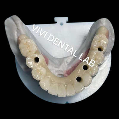 Multilayer Zirconia Sekrup Jembatan Bertahan Biokompatibel Pada Struktur Logam