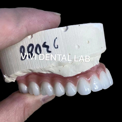 Natural Looking Esthetic Screw Retained Zirconia Implant Crown Langgeng