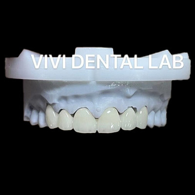 Dental Anterior Zirconia Bridge ISO Bersertifikat Waktu Turnaround Cepat