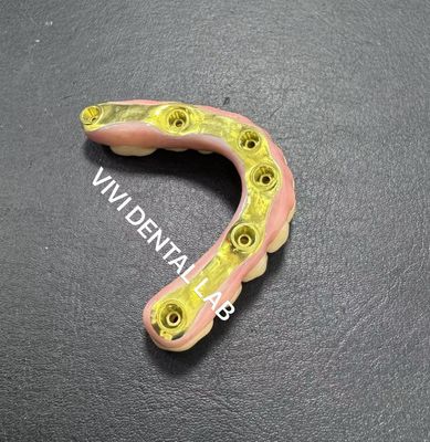Jembatan Zirconia penuh dengan Titanium Bar Support China Dental Lab