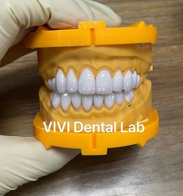 Ivoclar Emax Laminate Veneers Translucence Tinggi China Dental Lab