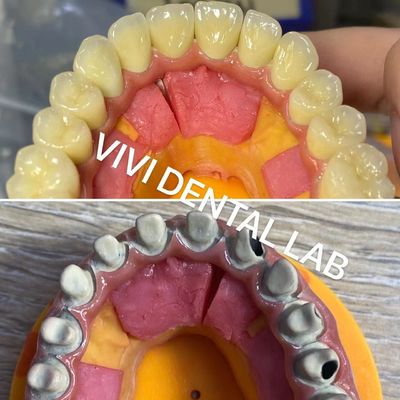 Ivoclar Digital Dental Crown Proses Noritake Porselen Keakuratan Tinggi