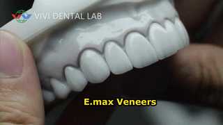 Laminasi Veneer Gigi