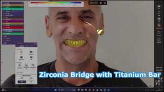 Zirkonia Bridge Titanium Bar Semua dalam Solusi X